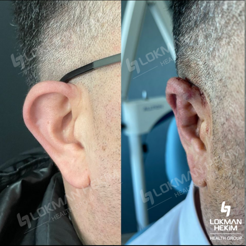 Ear correction surgery (Otoplasty) Before / After photo
